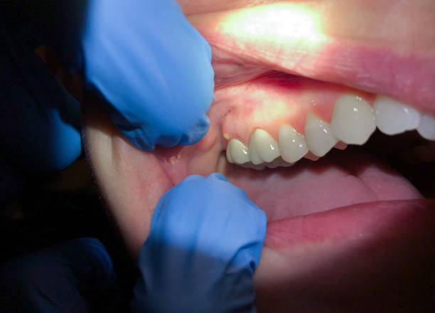 Best Emergency Treatment for Dental Infections or Abscesses in Arnold, CA